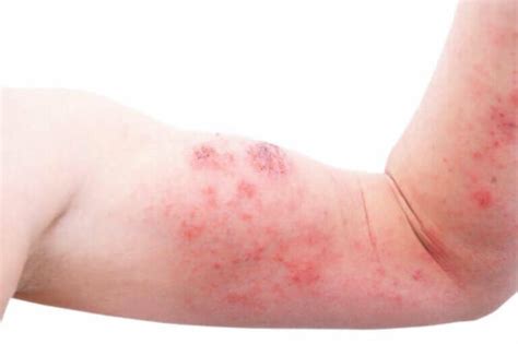 Petechiae in Babies: Causes, Symptoms, and Treatment