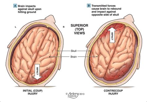 Diffuse Axonal Injury