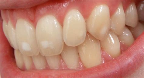 Fluorosis