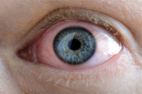 Glaucoma Eye Drops Chart