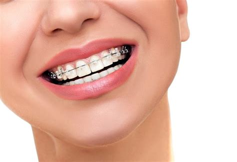 The Best Products For Whitening Teeth With Braces