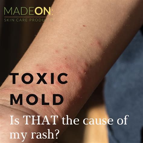 What Does A Mould Rash Look Like - Infoupdate.org