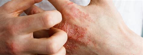 Eczema Treatments | Queens, NY | Glendale Dermatology