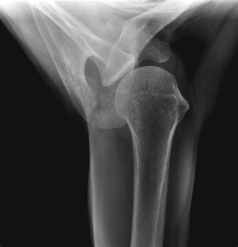 Acromion Fracture