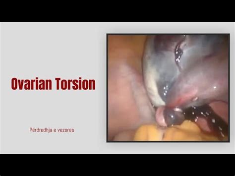 Torsion Ovarian - YouTube