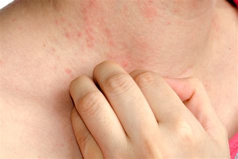 5 Symptoms Of Eczema That People Might Be Ignoring