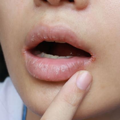 Angular Cheilitis Treatment, Causes, and Symptoms