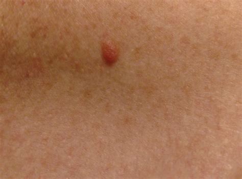 Desmoplastic Melanoma Masquerading as Neurofibroma | MDedge Dermatology