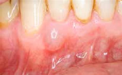 Lateral periodontal cyst. | Download Scientific Diagram