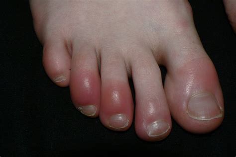 Acrocyanosis: Definition, Causes And Treatment