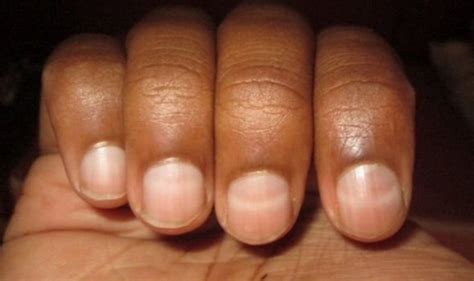 Fatty liver disease: Symptoms include nails that may whiten and develop stripes | Express.co.uk