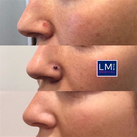 Skin Cancer / Mole Removal - LM Medical NYC