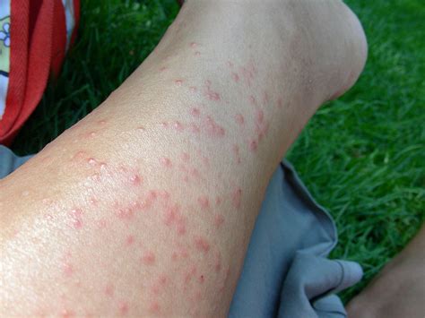 How To Treat Heat Rashes - Doctor Tipster