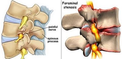 What is Neural Foraminal Stenosis (bilateral, mild, moderate, severe) Treatment | Health and ...