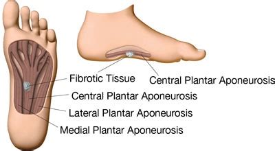 Blackmer Foot & Ankle | Plantar Fibroma in Meridian