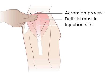 Intramuscular Injection | Injections, Im injection, Emergency nursing