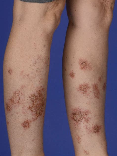[Figure, Nummular Dermatitis DermNet New Zealand] - StatPearls - NCBI Bookshelf