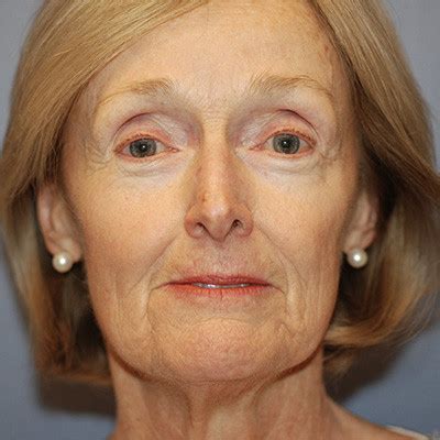 Facelift Case #4290 - Boston Plastic Surgery