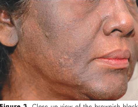 Figure 1 from Photodistributed macular amyloidosis presenting as diffuse facial pigmentation ...