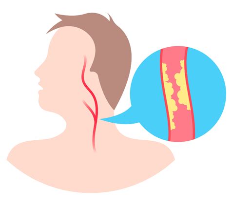 Carotid Stent Recovery Timeline | Supreme Vascular and Interventional Clinic