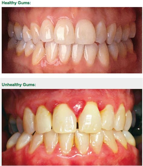 Healthy Vs Unhealthy Gums : Healthy vs Unhealthy food - YouTube, Maybe you would like to learn ...