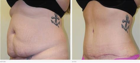 Tummy Tuck Scars After 2 Years Pictures