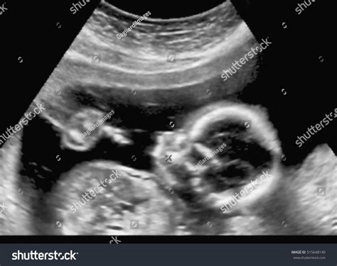 Medical Image Mothers Womb Ultrasound During Stock Photo 515648140 | Shutterstock