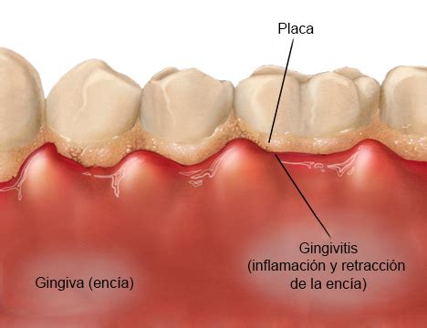 Vive Sana: Un remedio casero contra la Gingivitis