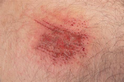 Abrasion Wound in Caucasian Skin Close Up Stock Image - Image of human, scab: 237993443