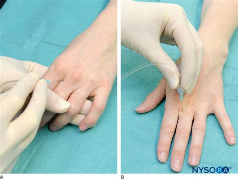 regional-anesthesia-identical-procedure-repeated-on-the-radial-side-of-proximal-phalanx-to-block ...