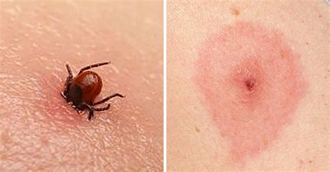 12 Common Bug Bites And How To Recognize Each One