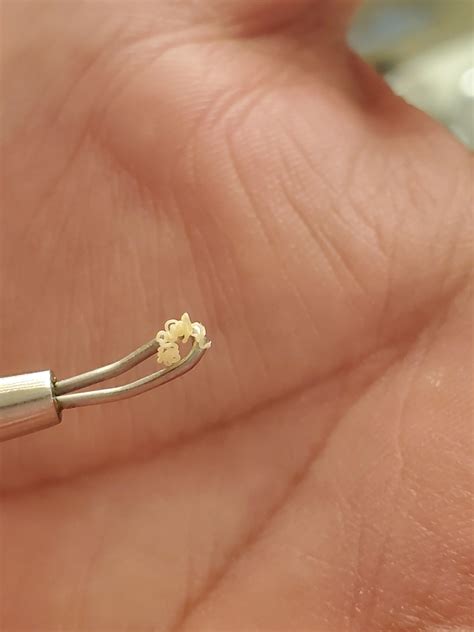 Look what came out of a recurring pimple in my ear : r/popping