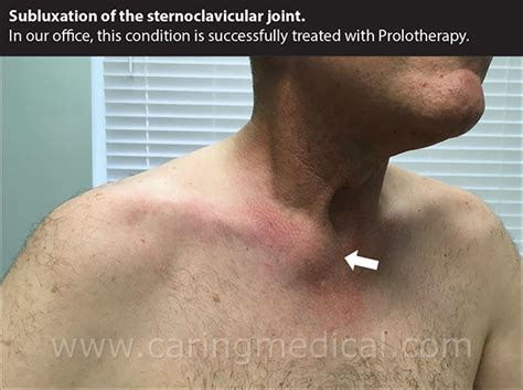 Sternoclavicular Joint Sprain