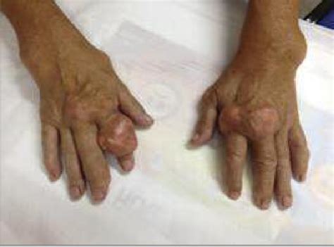 Things You Need To Know About Gouty Tophi In The Wrist | Get Rid Of Gout