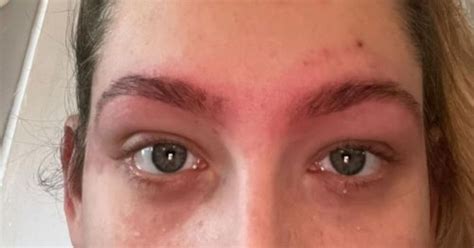 Mum hospitalised after horrific reaction to getting eyebrows tinted at ...