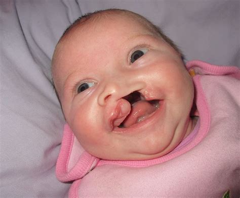 Cleft Lip & Palate Association | Cleft lip and palate, Cleft lip, Cleft ...