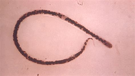 Clinical Treatment of Onchocerciasis | Filarial Worms | CDC