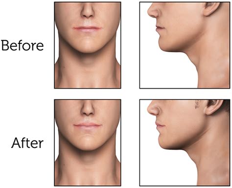 Male Lip Shapes Chart