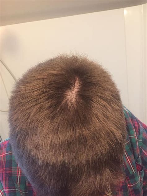 Cowlick or thinning crown? : r/bald