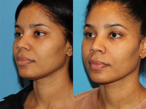 Neck Lift (Submentoplasty) Before and After Pictures Case 94 | Atlanta, Georgia | Buckhead ...