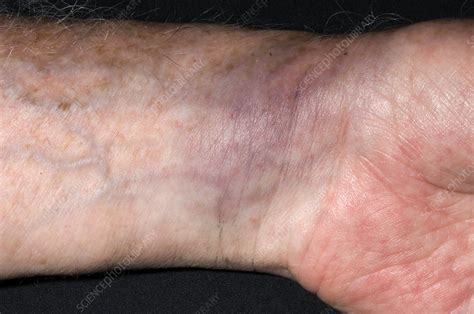 Bruised wrist - Stock Image - M330/1522 - Science Photo Library