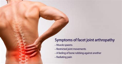 Facet Joint Arthropathy: Symptoms Causes Prevention and Treatment