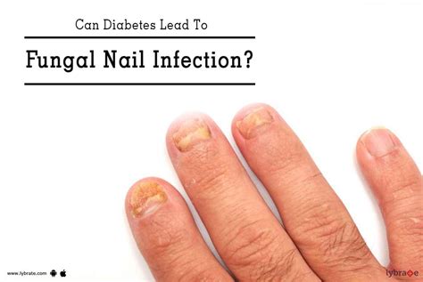 Can Diabetes Lead To Fungal Nail Infection? - By Dr. Raghuram Reddy ...