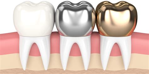 Different types of dental crowns | Birmingham Dental | Dentist MI 48009