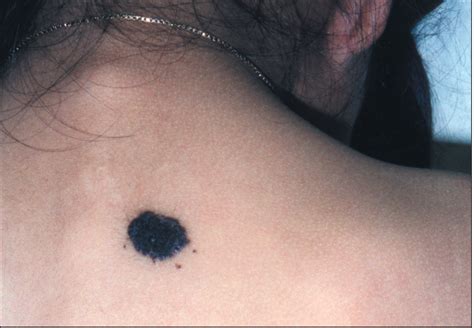 Photoclinic: Congenital Melanocytic Nevus | Consultant360