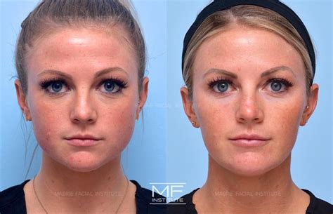 Juvederm Cheeks Before And After Photos