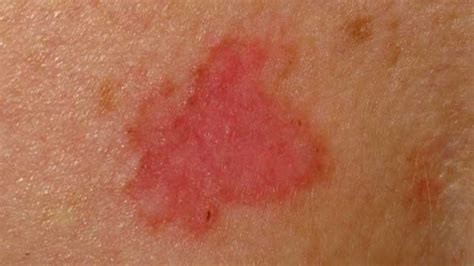 Itchy Red Spot Skin Cancer On Arm