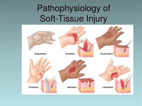 Ch05 soft tissue injury shorter