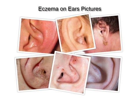 Eczema on Ear - How to Get Rid of Itchy or Dry Ear Eczema?