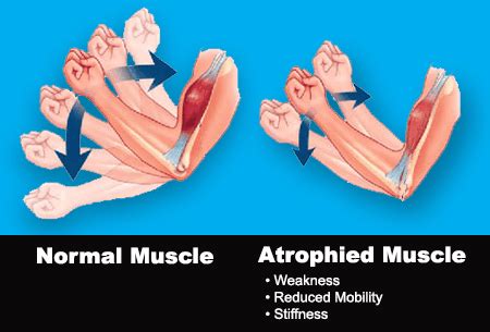 TENS & EMS Treats Muscle Atrophy - StimRx